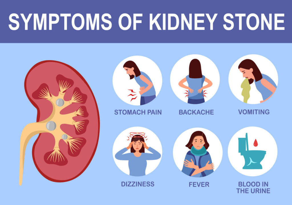 How To Cope with Kidney Stones Naturally