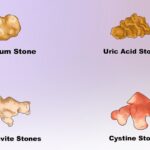 How To Cope with Kidney Stones Naturally? How To Cope with Kidney Stones Naturally
