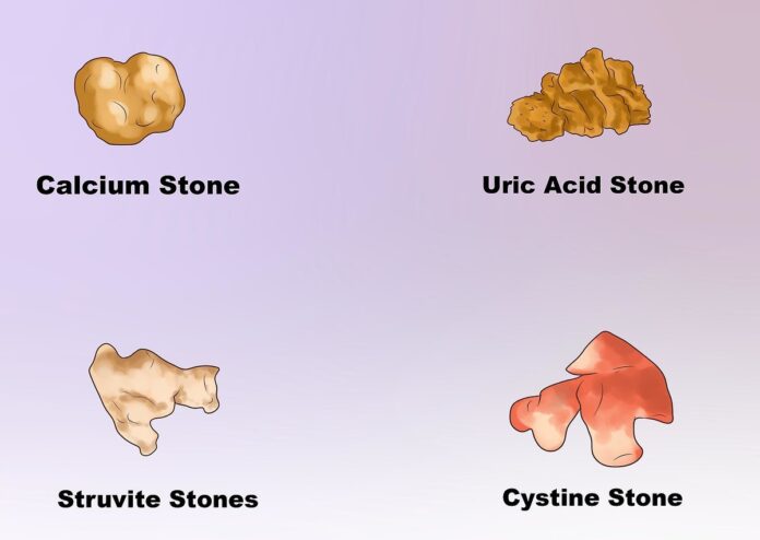 How To Cope with Kidney Stones Naturally